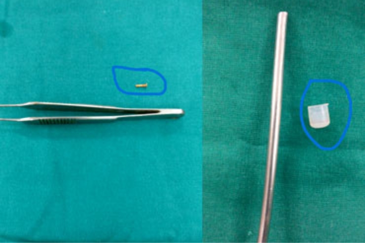 Foreing body removal