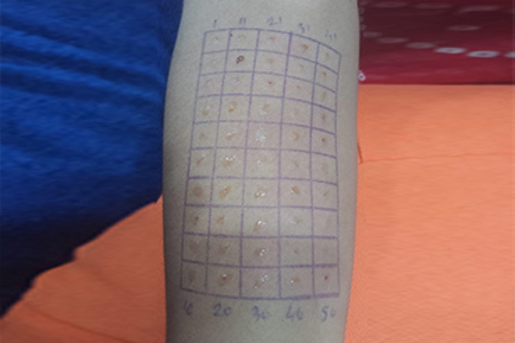 Skin Prick Allergen Testing